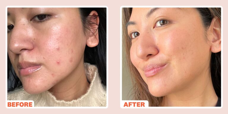 wh-index-beauty-beforeandafter-kr-microneedling-1614789818
