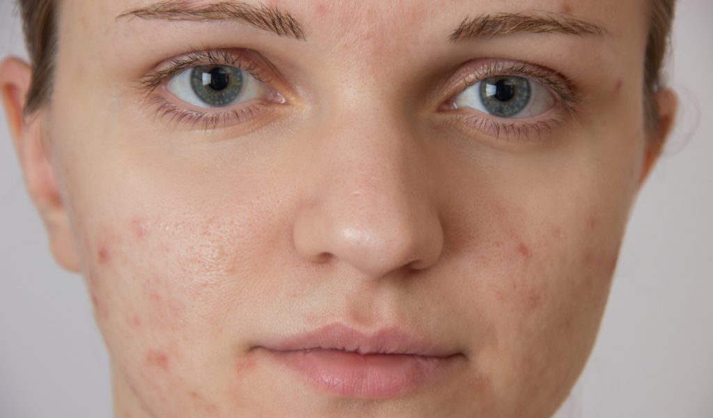 Beautiful young girl with acne on his face on a white background
