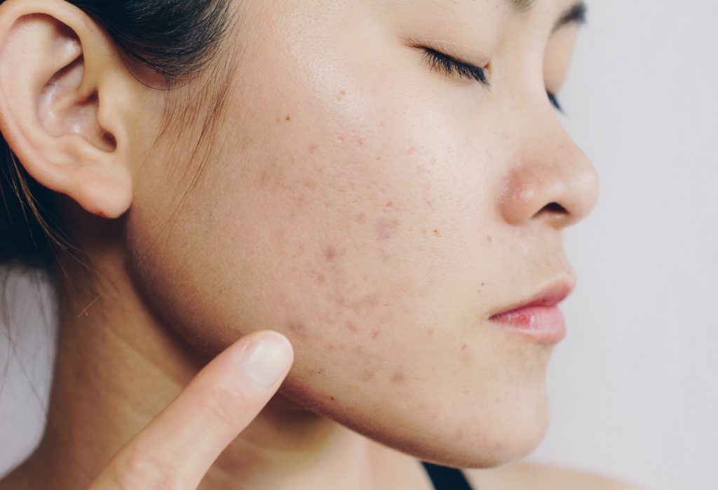 Portrait of Asian woman has problems with skin on her face. Problems with acne and scar on the female skin.